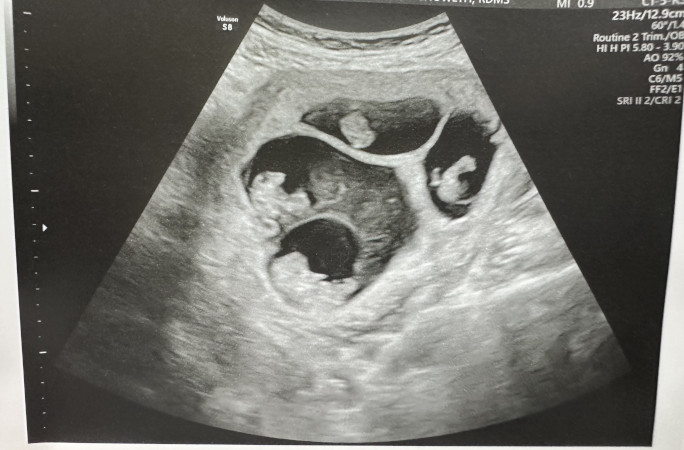 The quads' ultrasound