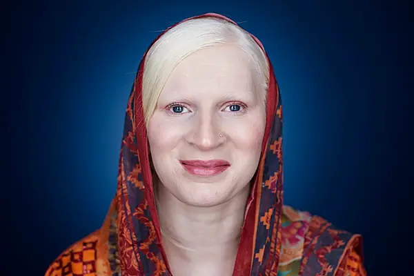 albino indian person