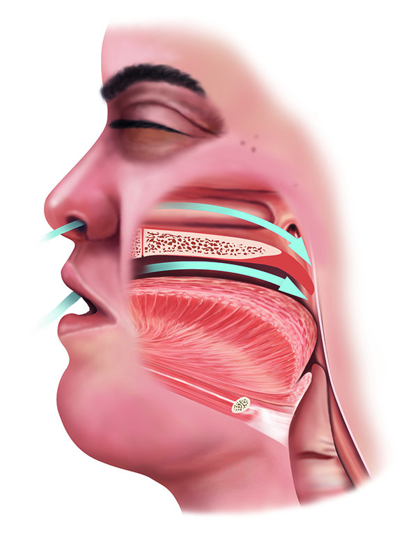 Illustration of sleep apnea 