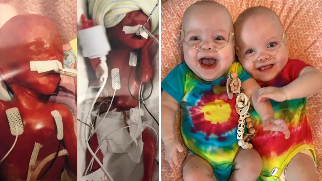 How the world’s most premature twins have defied the odds to celebrate
