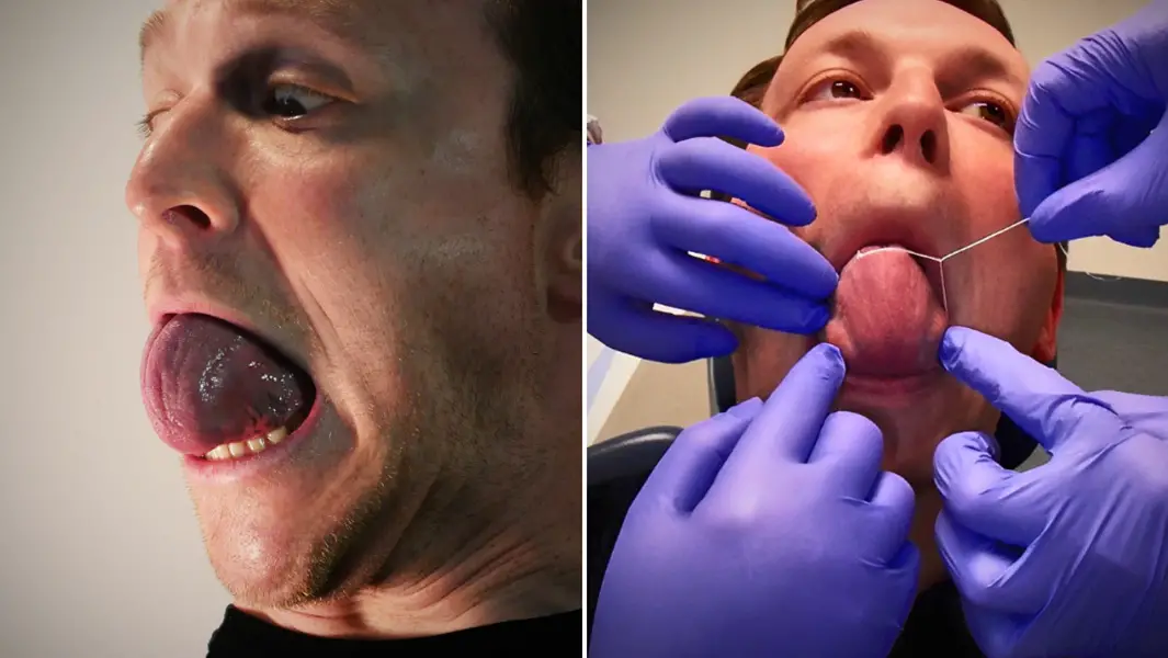 split image of Sacha expanding tongue