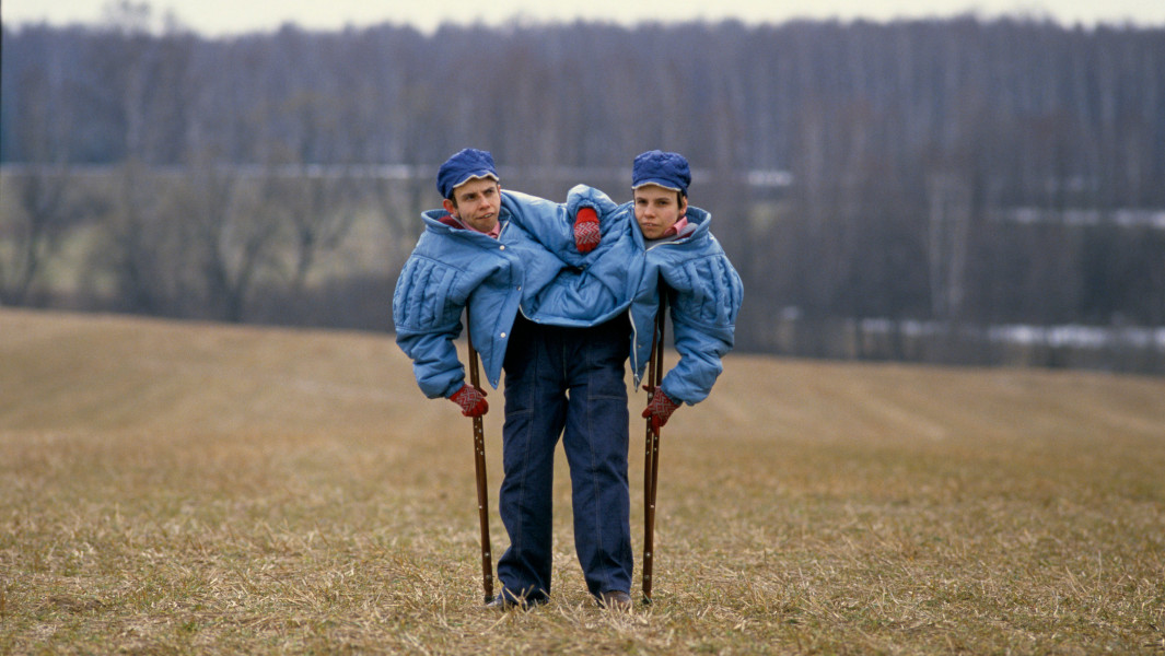 Split header image of Chang and Eng and a conjoined twin x-ray
