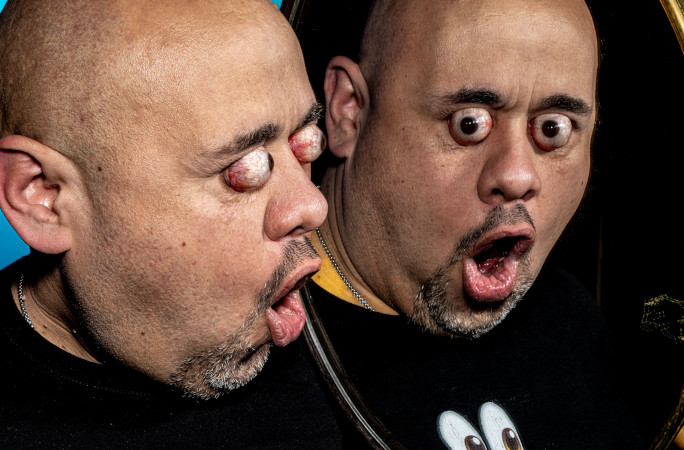 Man with farthest eye-ball pop on mirror