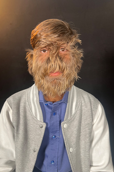 Boy with hairiest face