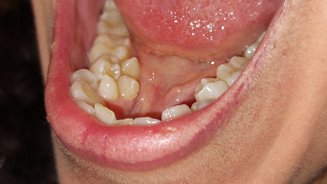 Split image of Sylvia in the dentist chair and a close up of her teeth