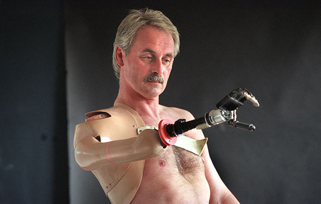 First bionic arm fitted on an individual (male)